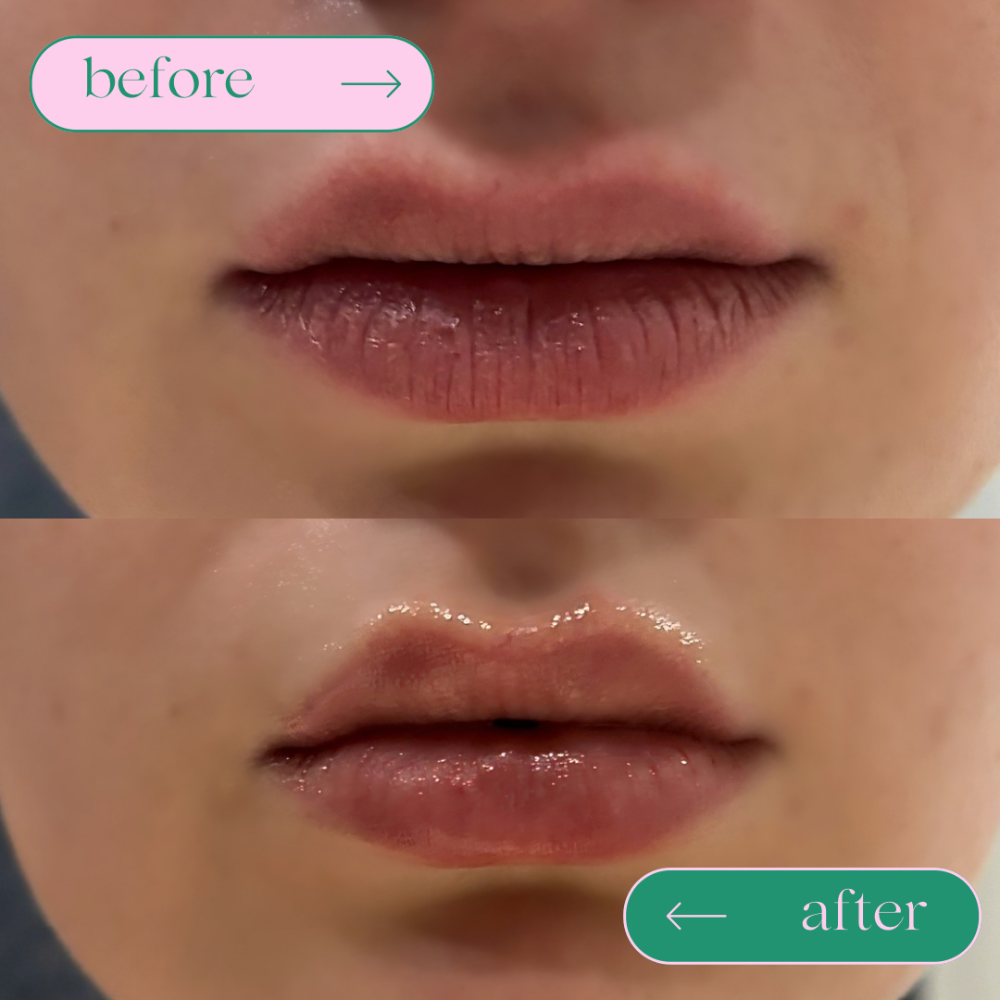 Pina Coco - Hyaplump Lip Balm